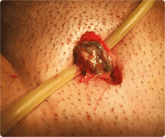 Varicocele Surgery