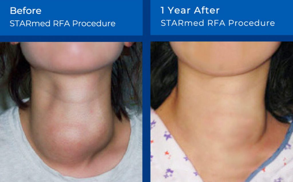Thyroid Embolization or RFA