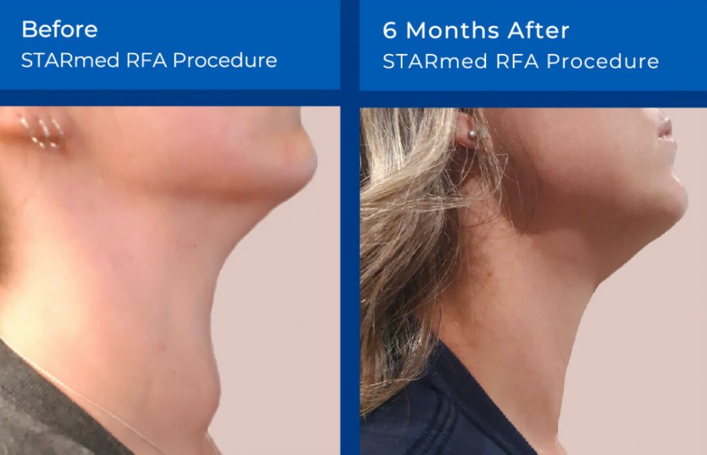 Thyroid Nodule RFA Large Top Best Doctor California Surgery