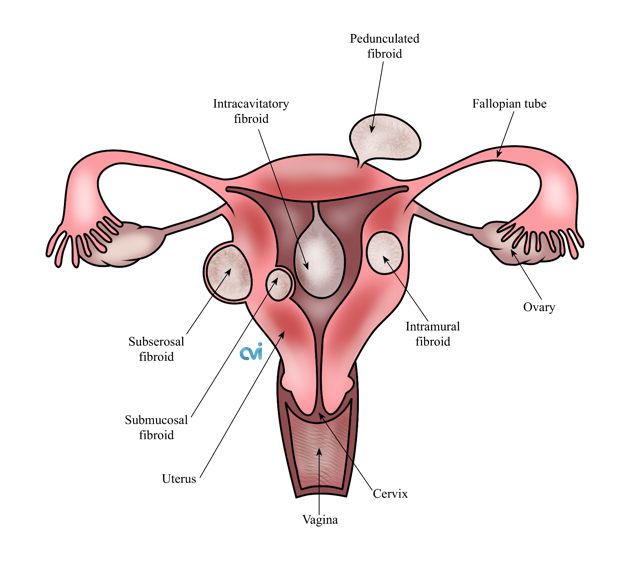 Myomectomy Surgical