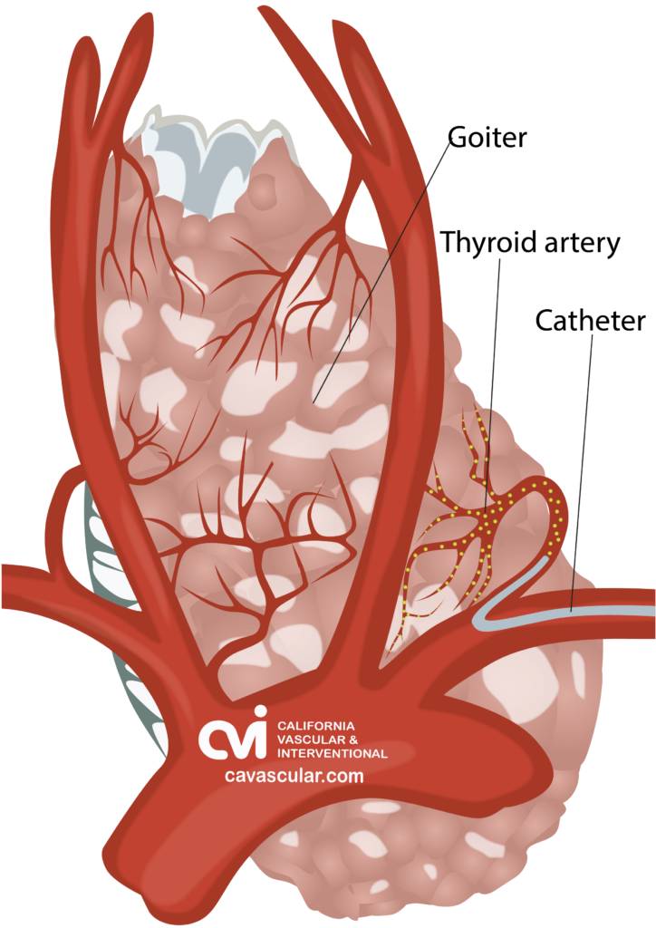 Thyroid Goiter Embolization Treatment