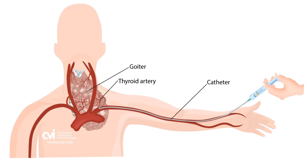 Non-Surgical Embolization California